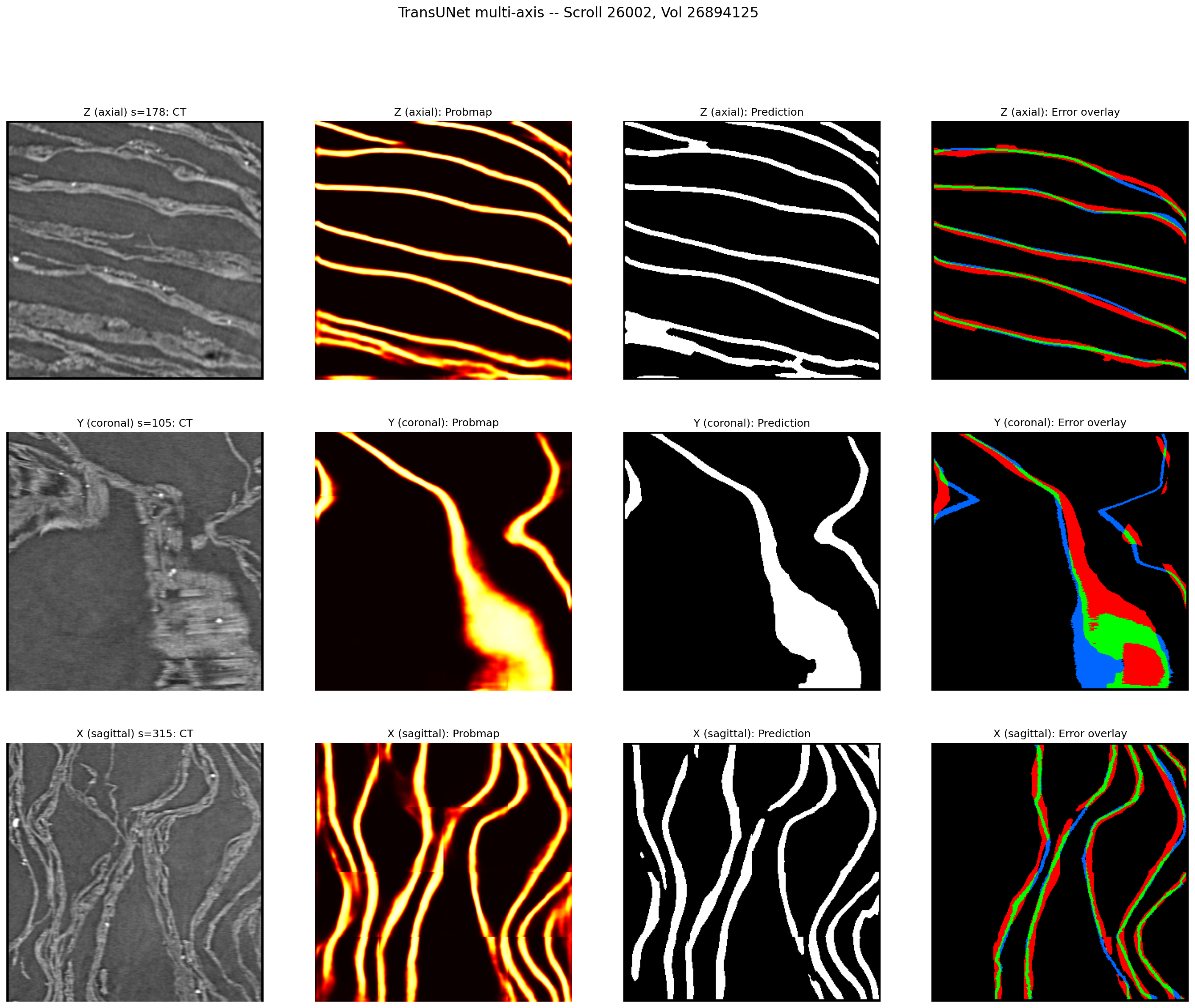 Multi-axis visualization of TransUNet predictions showing axial, coronal, and sagittal views with CT, probability maps, predictions, and error overlays